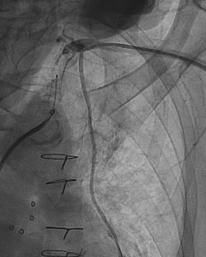 Follow-up on this case. Functioning LIMA to LAD. Retro radial crossing of SCA CTO 0.018, reversed system. Radial  to wire LIMA for protection (diseased ostium). 9mm BE stent. LIMA ostium treated at the end. This case was for angina/NSTEMI. Curious to hear VS colleagues’ approach.