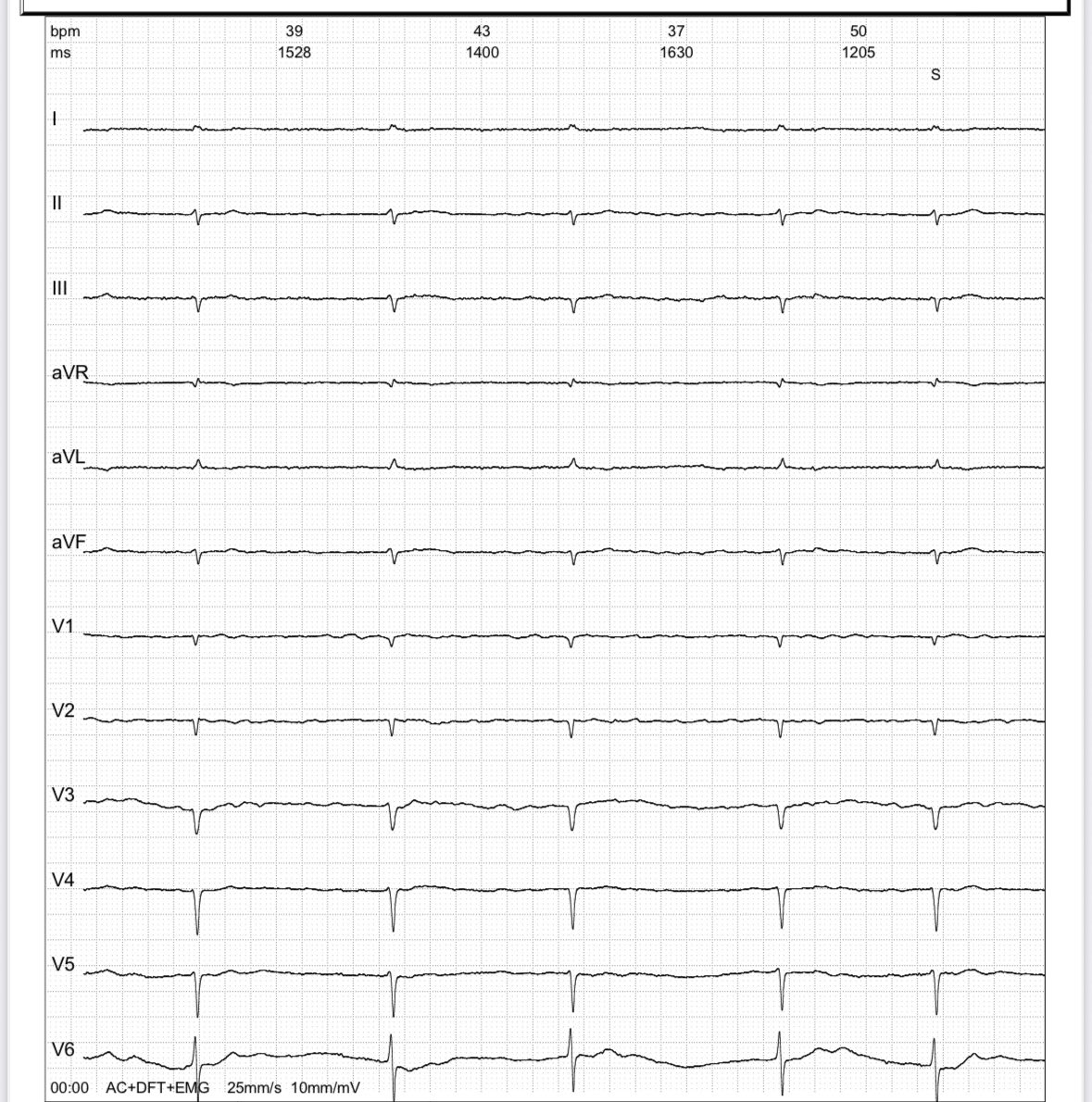 Norberto Bornancini (@cardiobornan) on Twitter photo Xq invertir en Asistencia Remota?
4 ojos ven mejor de 2?….y si tenes al cardiólogo mirando cada uno de los EKG.
👵🏻90 años. Le mandan ambulatorio para realización de EKG x mareos intermitentes.
Llegar antes…siempre!
Ayudar… desde donde estés! Xq invertir en Asistencia Remota?
4 ojos ven mejor de 2?….y si tenes al cardiólogo mirando cada uno de los EKG.
👵🏻90 años. Le mandan ambulatorio para realización de EKG x mareos intermitentes.
Llegar antes…siempre!
Ayudar… desde donde estés!