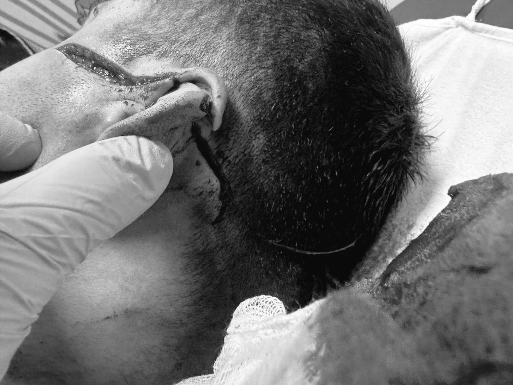 infazkorumalar's tweet image. Alttaki resim malesef görevi başındaki bir İnfaz Koruma Memuruna ait
Ne mi olmuş kendine emanet edilen ve güvenligi sağladığı bir mahkum tarafından hain saldırıya uğradı ve bu halde
 şimdi kim ailesine bu durumu anlatacak.
#YeterArtık
#İnfazKorumayaSaldırıSonBulsun 
#GeçmişOlsun