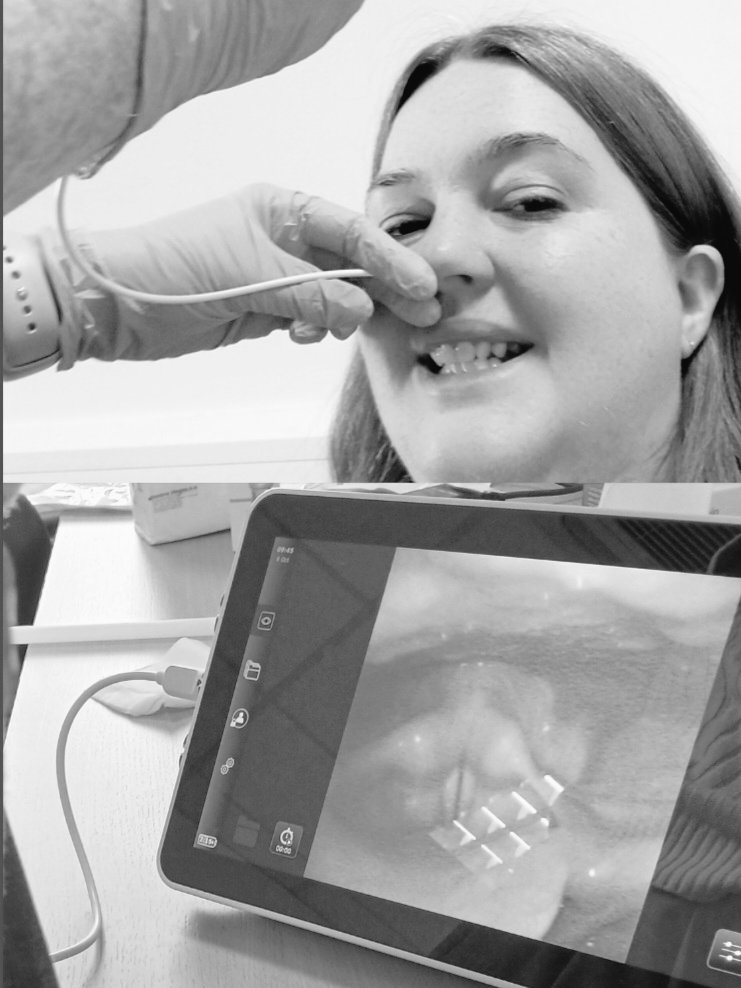 AchieveSpeech's tweet image. (Bravely) offering my vocal folds in the prep for roll out of mobile #FEES for #dysphagia in Donegal Primary Care and LUH SLT Depts! Scoping thanks to Emma McKelvey, SSLT, Level 3 FEES practitioner. @IASLPeeps