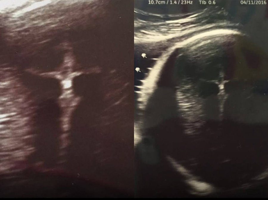 trad_west_'s tweet photo. Cross-like shape appears on woman's ultrasound.
In 2016, a mother in Indiana went for a routine ultrasound. Next to the image of her unborn child, a figure appeared with arms outstretched, resembling Jesus Christ on the Cross.
The story spread quickly and was picked up by news outlets worldwide. Some said it was just coincidence.
But for the mother, who was struggling with Crohn’s disease and worried for her baby, it was a powerful sign of God’s presence and reassurance.