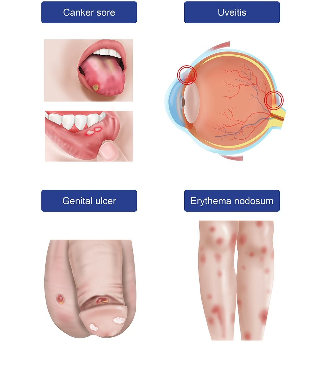 A patient presents with recurrent oral ulcers, genital ulcers, erythema nodosum and uveitis.

A) Reiter’s syndrome
B) Behçet’s disease
C) SLE
D) Sarcoidosis