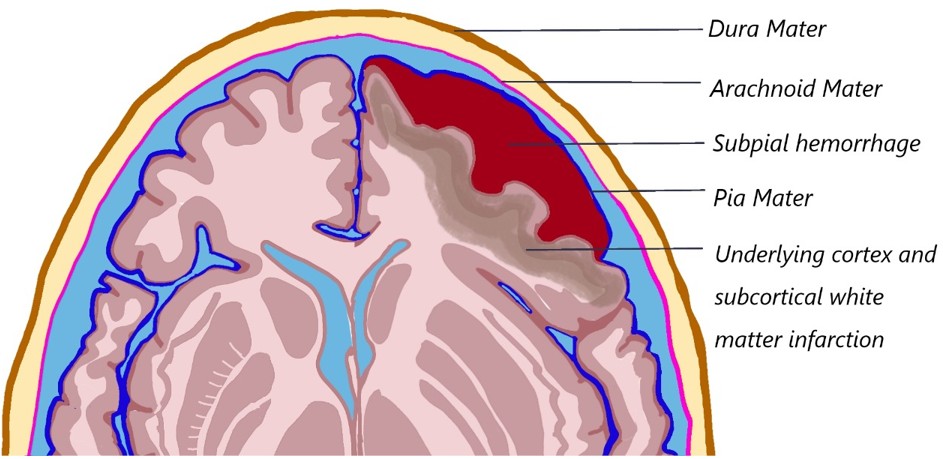 This week’s SPIN-POV: Subpial haemorrhage is an uncommon but distinct neonatal bleed, appearing as a curvilinear collection along the cortical surface with an intact pial margin. It can mimic subarachnoid haemorrhage but shows restricted diffusion in the subjacent cortex.