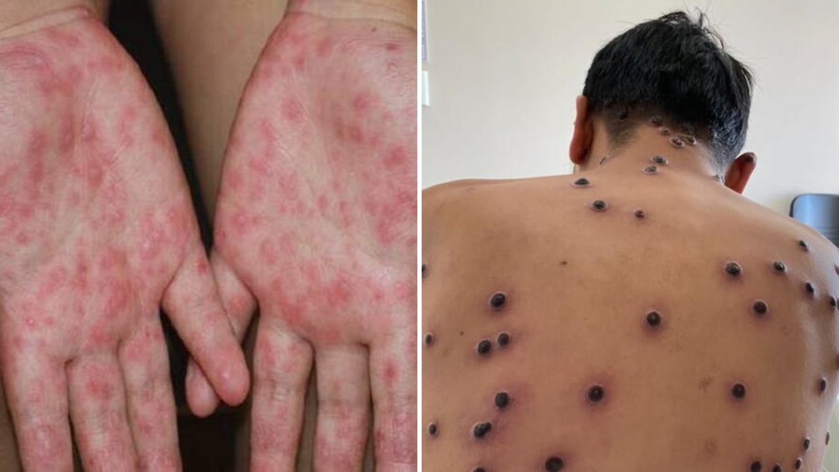 NoticiasCuautla's tweet image. #Local || Sin reporte en Cuautla sobre casos de Coxsackie y viruela símica.
noticiasdecuautla.mx/cuautla-libre-…