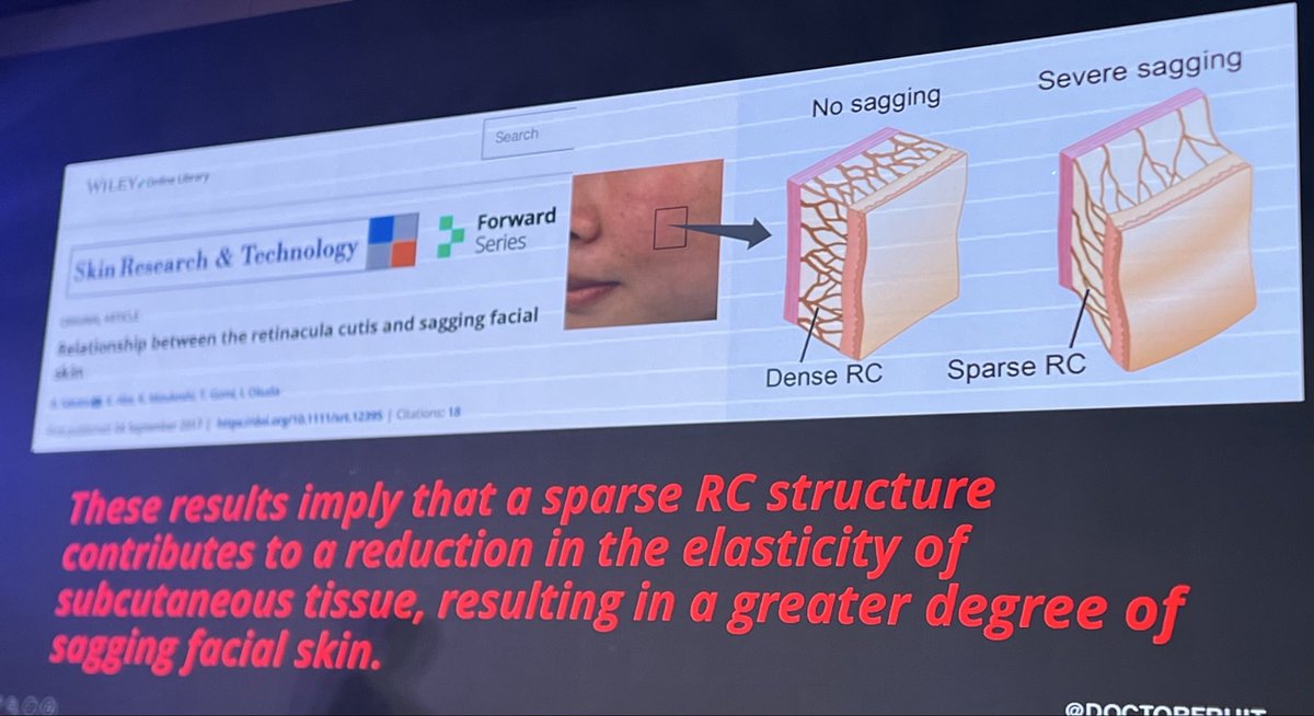 DrSuparuj's tweet image. กลไกลที่ Monopolar RF ช่วยยกกระชับผิว โดยจะปล่อยพลังงาน RF ไปทำให้เกิดความร้อน Heating ที่
•Retinacular cutis = Septal Heating 
+ Retaining ligament = Ligament Heating ครับ #monopolarrf