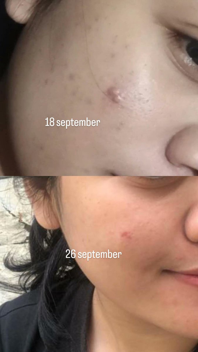 buat para acne fighter merapat! kalian harus tau ada totol jerawat yg beneran bagus bgt dan seampuh itu!

gapernah sejatuh cinta ini sama salah satu produk yg bisa sembuhin jerawat aku dgn waktu yg cepet🥹