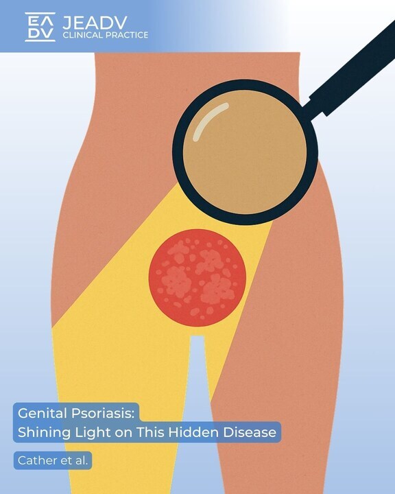 #Genitalpsoriasis affects sensitive areas like the vulva, penis, scrotum &amp; intergluteal cleft, requiring careful #diagnosis &amp; treatment. 
Cather et al. report 14 consensus statements on diagnosis, #QoL, and #treatment decisions.

Full article 👉 bit.ly/3V3O3Lw
