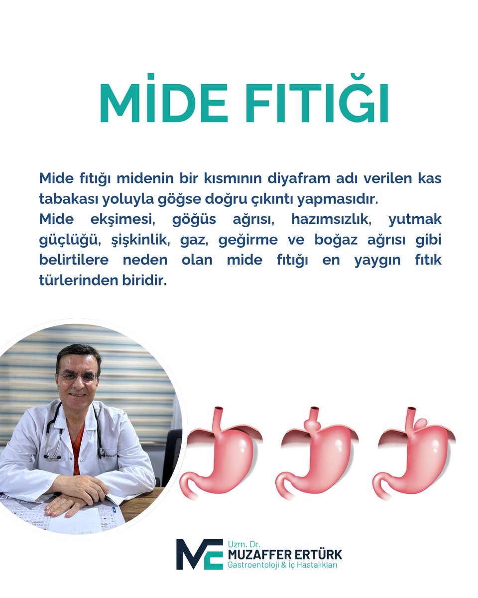 Mide fıtığı midenin bir kısmının diyafram adı verilen kas tabakası yoluyla göğse doğru çıkıntı yapmasıdır. Mide ekşimesi, göğüs ağrısı, hazımsızlık, yutmak güçlüğü, şişkinlik, gaz, geğirme ve boğaz ağrısı gibi belirtilere neden olan mide fıtığı en yaygın fıtık türlerinden biridir