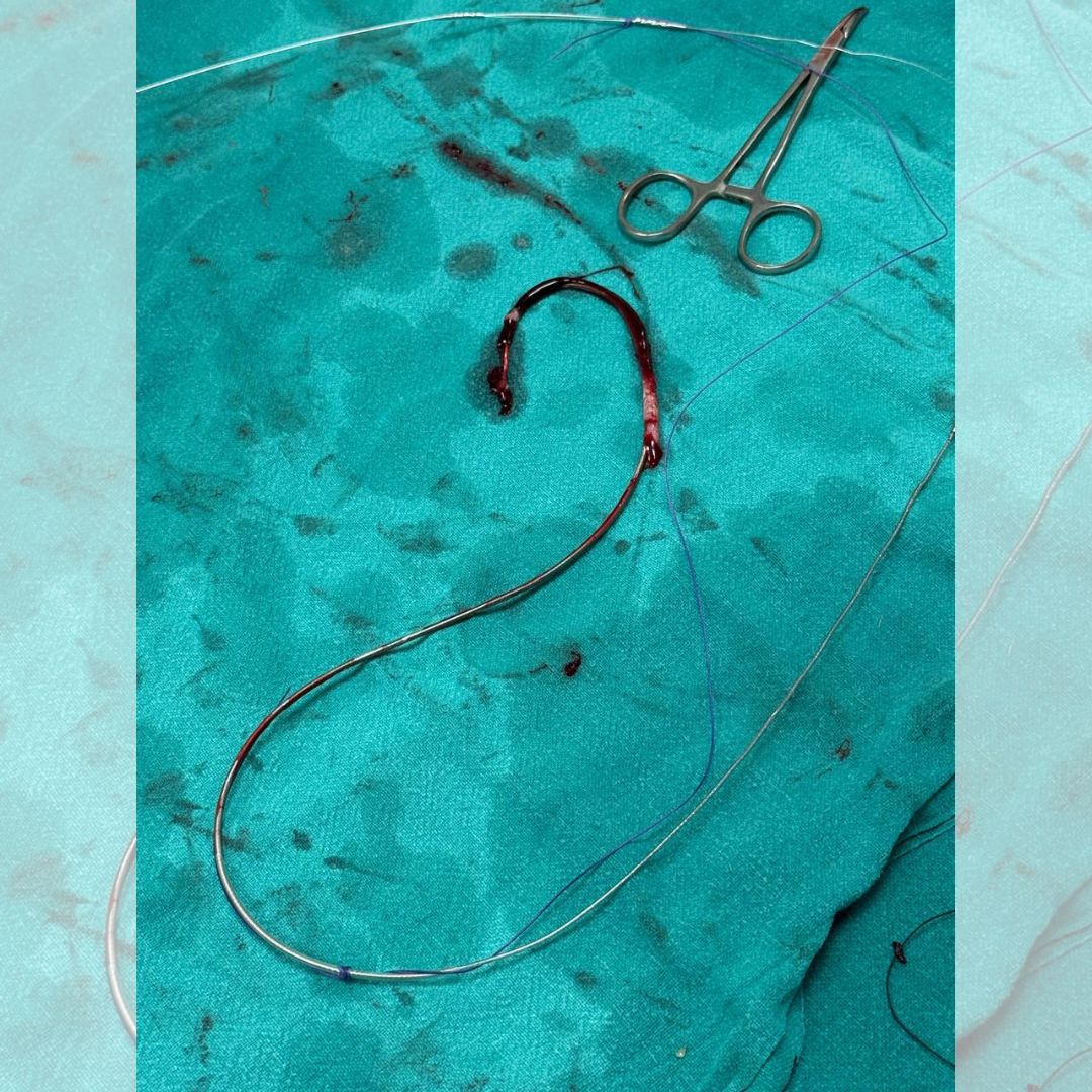 Dr_Vivekakumar's tweet image. Pan Max Healthcare Performs First Successful LASER Lead Extraction of Over 10-Year-Old Dual Chamber AICD Leads

#maxhealthcare #cardiology #laserleadextraction #aicd #cardiaccare #maxhospitalsaket #heartspecialist #drvivekakumar #cardiologist #cardiologistdelhi