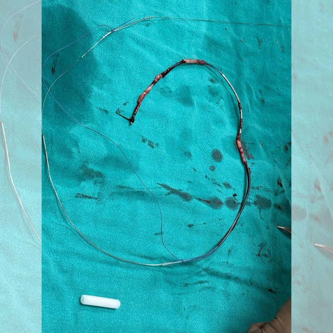 Dr_Vivekakumar's tweet image. Pan Max Healthcare Performs First Successful LASER Lead Extraction of Over 10-Year-Old Dual Chamber AICD Leads

#maxhealthcare #cardiology #laserleadextraction #aicd #cardiaccare #maxhospitalsaket #heartspecialist #drvivekakumar #cardiologist #cardiologistdelhi