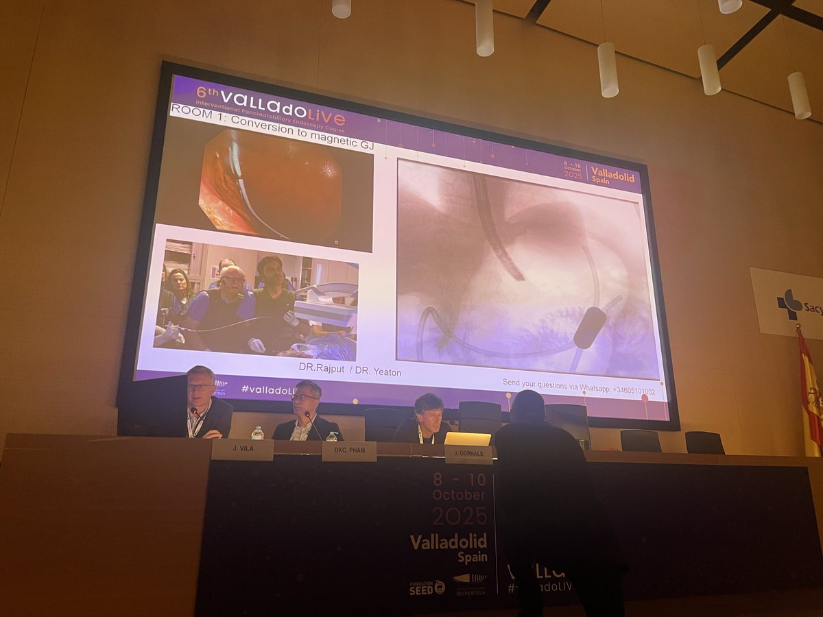 Excellent demonstration by Dr. Sanjay Rajput 🇮🇳 on conversion to magnetic gastrojejunostomy‼️

A wonderful example of advancing endoscopic innovation.

<a href="/EndoscopyOA/">Endoscopy On Air</a> #Valladolidlive2025