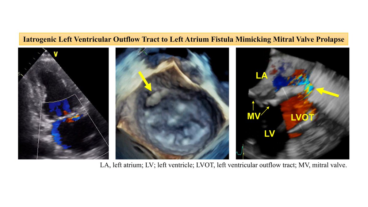 JCIRC_IPR's tweet image. We report a case of left ventricular outflow tract to left atrium fistula that was misinterpreted as mitral valve prolapse because of a similar appearance of the jet.
By Hiroki Okamoto
doi.org/10.1253/circre…
#circ_rep #CardioX
