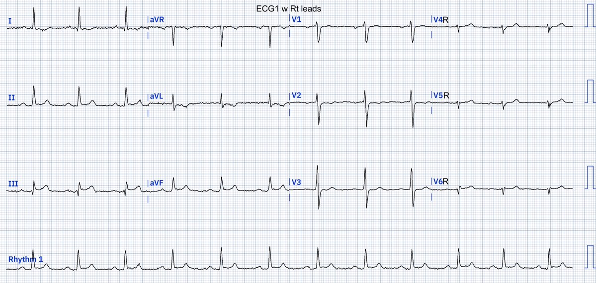 EcgOxford's tweet image. CP
Ctnl 0
Dx?
@akneton @yolyabreuh @UlhasDr @DidlakeDW @ecgrhythms @IhabFathiSulima @DrPharmDMDTh @Vadeboncoeur_Al @smithECGBlog @EM_RESUS @estudiomedicina @OrlandoRPN @fxgodzeuss #EPeeps #FOAMcc @ResusMed @TrRja @NaokiThukishima @ecgandrhythmRoe