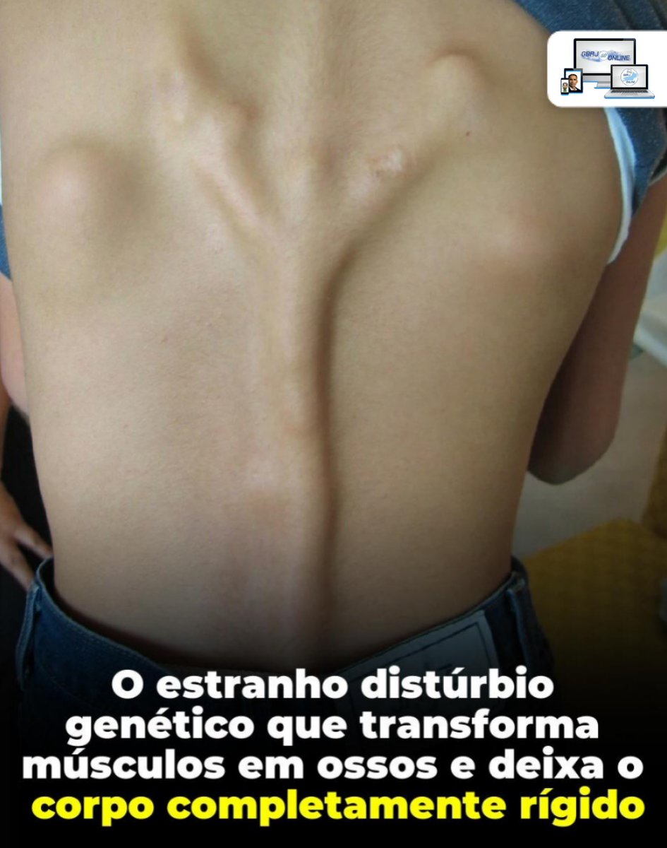 FabiRaiz's tweet photo. Insano!🤯
A Fibrodysplasia Ossificans Progressiva é uma doença genética extremamente rara que faz com que tecidos moles, como músculos e tendões, se transformem em osso. 
.
Ela ocorre em aproximadamente uma pessoa a cada dois milhões de nascimentos e não possui cura conhecida. 👇🏼 https://t.co/E7WO46mRAX