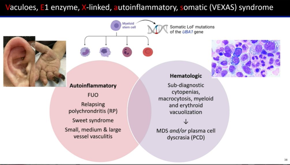 MPN_Hub's tweet image. CONGRESS | #IACH | PRESENTATION
Naveen Pemmaraju @doctorpemm, @MDAndersonNews, discusses rare hematologic malignancies with a focus on MLNFGFR1, BPDCN, MDS/MPN and CNL, RDD and RALD with malignant transformation, and VEXAS syndrome, emphasizing that these diseases may directly…
