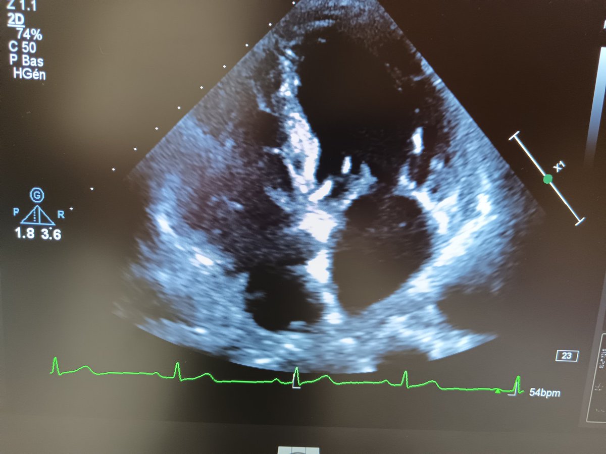 FibrilloFlutter's tweet image. What do you think about these structural findings in the sub-mitral region ⁉️
@DrRajeshG1 @alex1708ander @argulian @lukasz_zydzik