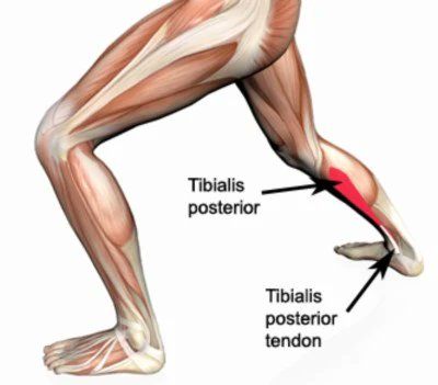 Barefoot_Will_'s tweet photo. Over-pronators are prone to suffering from PTTD (Posterior Tibial Tendon Dysfunction) 

1. Ankle Pronation 
2. Collapse of the Arch 
3. Lack of Big Toe Control 
4. Excessive Tibial External Rotation 
5. Uncontrolled Hip Internal Rotation

All common biomechanical deficiencies I see within people who tend to over-pronate  

A main contributor to these patterns is due to a weakness within the Posterior Tibialis  

The Posterior Tibialis is one of the primary 'supporting' muscles of the arch of the foot  

Strengthening the Posterior Tib is a critical for recovery from PTTD (example exercise in post below)

But as I said, PTTD isn't just a Posterior Tibialis issue..

Over-Pronation creates a kinetic chain disaster & it's vitally important to the address the issue through a collective "From the Ground Up" approach