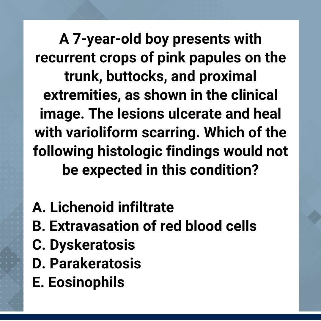 Friday Pop Quiz is live! 🧠 Can you guess the diagnosis? Reply A–E + a one‑line rationale. See the answer &amp; explanations at Next Steps in Derm: ow.ly/JeRf50X9O3L 

#FridayPopQuiz #DermBoards