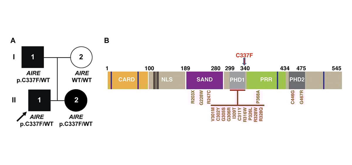 jhumimmunity's tweet image. Vemula, Pinzon-Charry et al. describe a novel heterozygous variant in AIRE in 3 individuals with mild #APECED. This variant was validated as being pathogenic by a mechanism of negative dominance. This represents new cases of autosomal dominant APECED. hubs.la/Q03N5ByW0