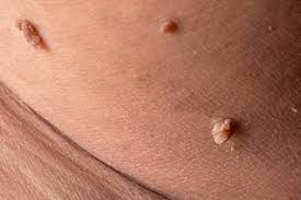 robertlufkinmd's tweet photo. Please don't ignore skin tags.

They are often a cutaneous marker 
for impaired carbohydrate metabolism
and metabolic dysfunction. 

“skin tags should be considered 
clinical markers of hyperinsulinemia.”

https://t.co/B20P6wkqYw. https://t.co/dMs2S0KVOi