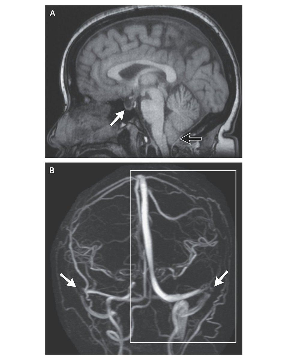 NEJM (@nejm) on Twitter photo 𝗡𝗲𝘂𝗿𝗼𝗶𝗺𝗮𝗴𝗶𝗻𝗴 𝗮𝗻𝗱 𝗜𝗺𝗽𝗹𝗶𝗰𝗮𝘁𝗶𝗼𝗻𝘀 𝗳𝗼𝗿 𝗣𝗮𝘁𝗵𝗼𝗽𝗵𝘆𝘀𝗶𝗼𝗹𝗼𝗴𝘆 𝗼𝗳 𝗜𝗱𝗶𝗼𝗽𝗮𝘁𝗵𝗶𝗰 𝗜𝗻𝘁𝗿𝗮𝗰𝗿𝗮𝗻𝗶𝗮𝗹 𝗛𝘆𝗽𝗲𝗿𝘁𝗲𝗻𝘀𝗶𝗼𝗻 
The term “pseudotumor” is apt, because the presence of an intracranial mass lesion must be ruled out for a 𝗡𝗲𝘂𝗿𝗼𝗶𝗺𝗮𝗴𝗶𝗻𝗴 𝗮𝗻𝗱 𝗜𝗺𝗽𝗹𝗶𝗰𝗮𝘁𝗶𝗼𝗻𝘀 𝗳𝗼𝗿 𝗣𝗮𝘁𝗵𝗼𝗽𝗵𝘆𝘀𝗶𝗼𝗹𝗼𝗴𝘆 𝗼𝗳 𝗜𝗱𝗶𝗼𝗽𝗮𝘁𝗵𝗶𝗰 𝗜𝗻𝘁𝗿𝗮𝗰𝗿𝗮𝗻𝗶𝗮𝗹 𝗛𝘆𝗽𝗲𝗿𝘁𝗲𝗻𝘀𝗶𝗼𝗻 
The term “pseudotumor” is apt, because the presence of an intracranial mass lesion must be ruled out for a