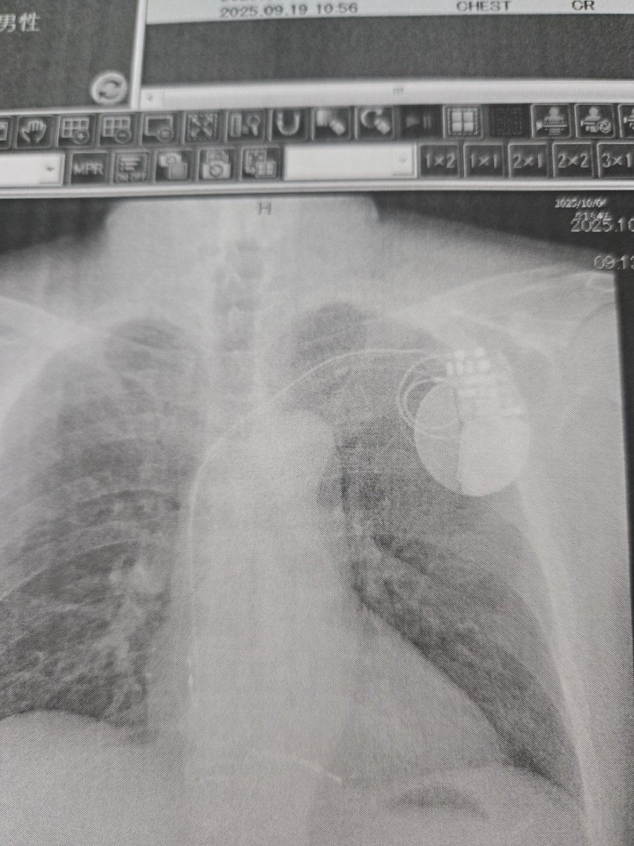 charandken's tweet image. 9/19に倒れ電車内&amp;amp;駅構内で声かけてくださった方や救急隊の方病院の主治医&amp;amp;看護師の方医専の研修の学生さん&amp;amp;教師の方、フォロワーさん術後リハビリして歩けるようになり今日無事退院します😢色々心配かけてすんませんでした&amp;amp;本当に感謝しかありません🙏🏻✨
 #いつもRPイイね泣けるリプありがと
  #ICD