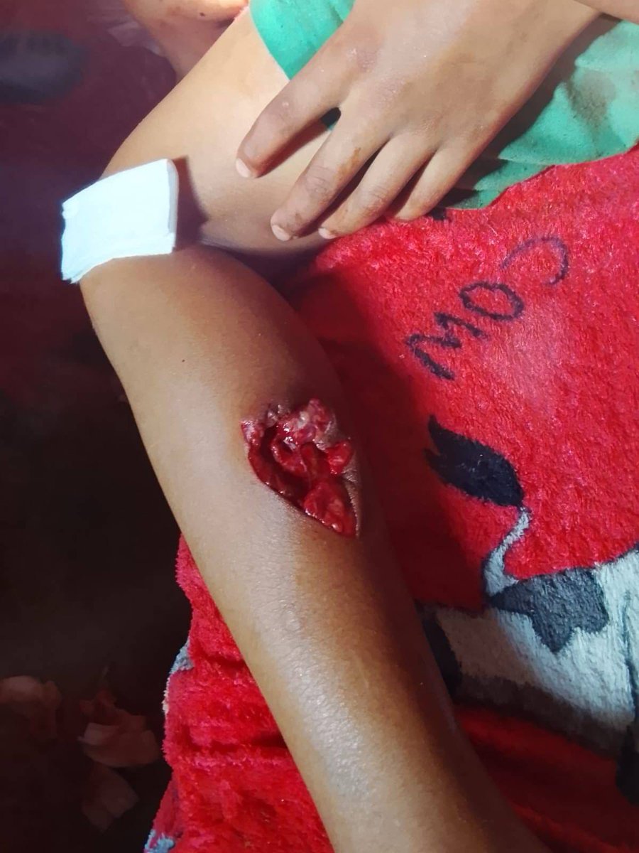 StephBatesPress's tweet image. 🚨#SurDeBolivar Esta noticia quizás no tenga la atención nacional ni internacional, porque no tiene la palanca mediática que tiene lo de Gaza, pero aquí, en Colombia, un menor fue víctima de un ataque con dron lanzado por el #ELN en la zona rural del corregimiento de Mina Chocó,…