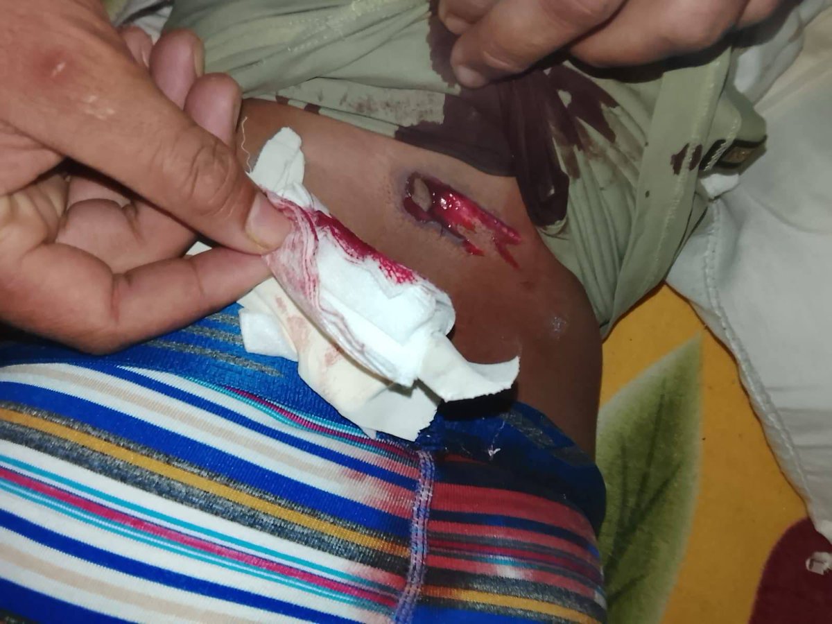 StephBatesPress's tweet image. 🚨#SurDeBolivar Esta noticia quizás no tenga la atención nacional ni internacional, porque no tiene la palanca mediática que tiene lo de Gaza, pero aquí, en Colombia, un menor fue víctima de un ataque con dron lanzado por el #ELN en la zona rural del corregimiento de Mina Chocó,…