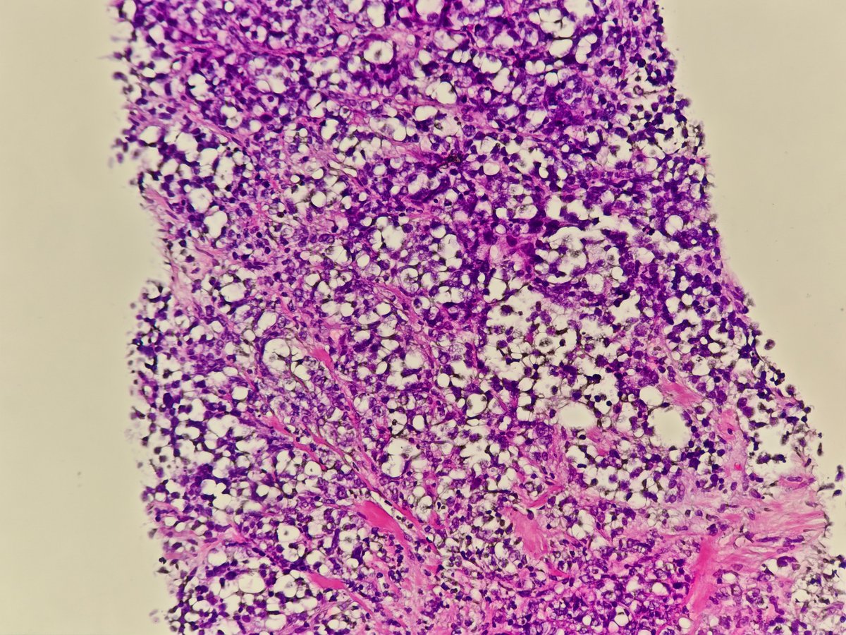 MirunaPopescu13's tweet image. DLBCL, NOS showing signet ring cell-like morphology.

#hemepath #PathTwitter