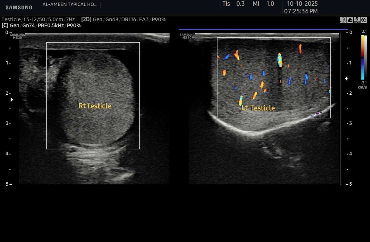 EchoTech_4's tweet image. 16 years male patient came with Acute RT testicular pain since 5 hours. 

Your opinion?

#EchoTech
