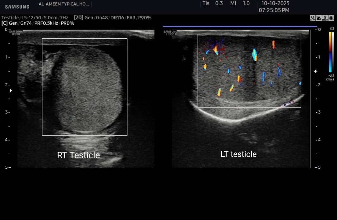 EchoTech_4's tweet image. 16 years male patient came with Acute RT testicular pain since 5 hours. 

Your opinion?

#EchoTech