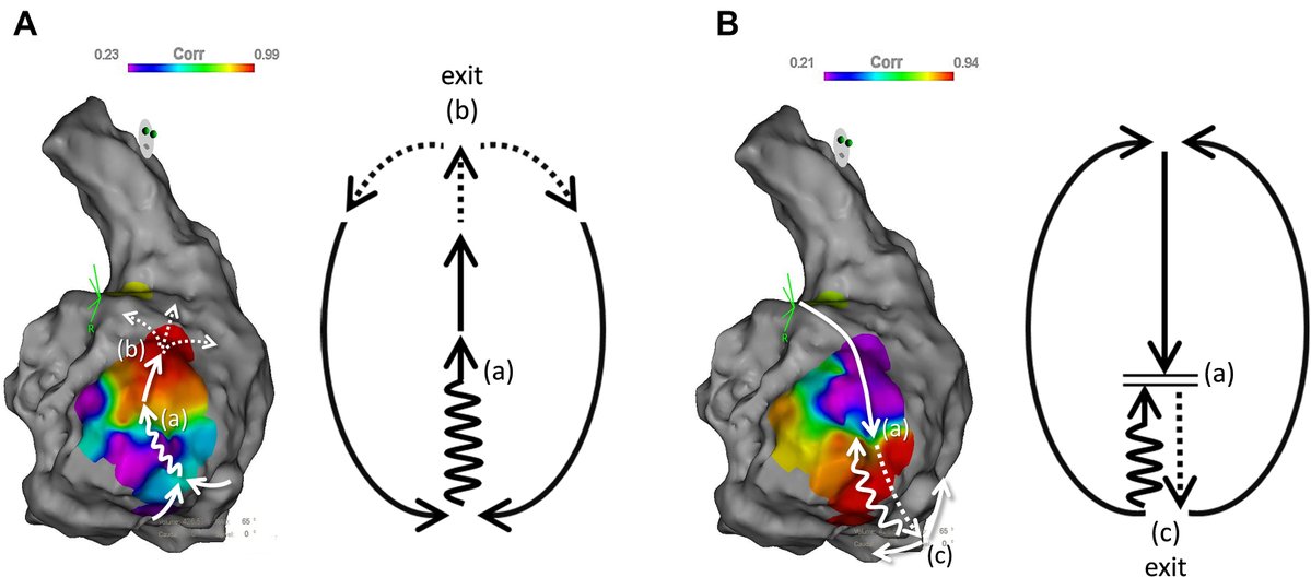 AkihikoNogami's tweet image. Elimination of VT and PVC by Ablation of Oppositely Directed Re-Entrant Circuits
-PVC ablation at a site other than the earliest activation site
authors.elsevier.com/a/1lv-7,siTgof…