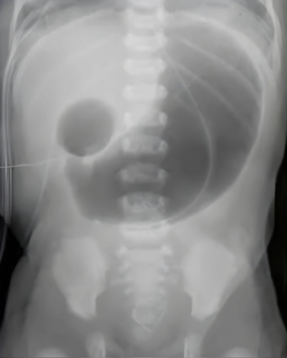 nervemed's tweet photo. What is the most likely diagnosis❓

A. Sigmoid Volvulus
B. Pyloric Stenosis
C. Meconium Ileus
D. Duodenal Atresia https://t.co/mtoP3mMYsA