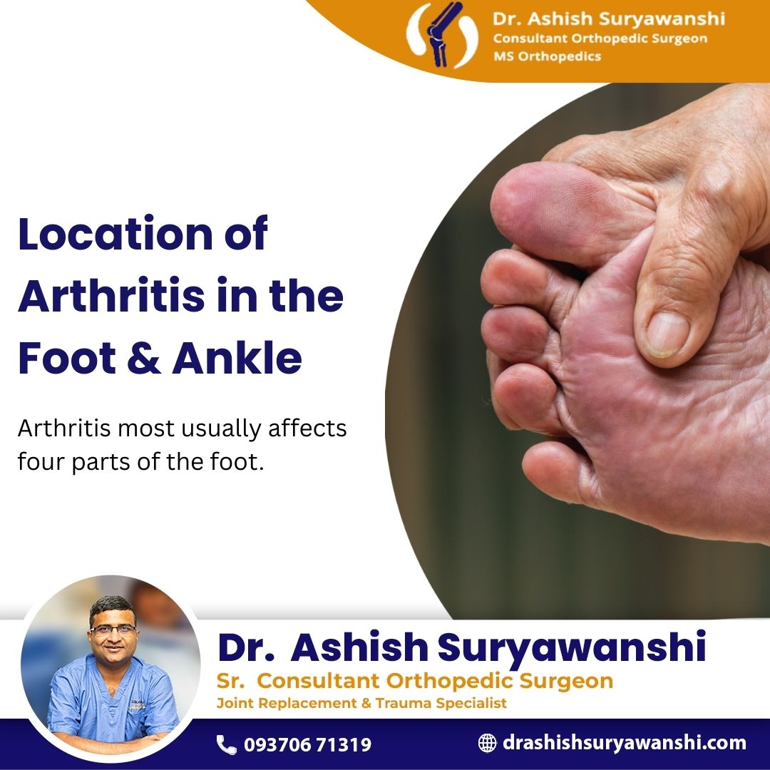 ashish_surgeon's tweet image. Location   of Arthritisinthe Foot and Ankle
Arthritis most usually affects four parts of the foot.
#FootArthritis #AnkleArthritis #ArthritisCare #OrthopedicCare #HealthyJoints #PainFreeLiving   #StayActive #RegainMobility #ExpertCare #JointHealth