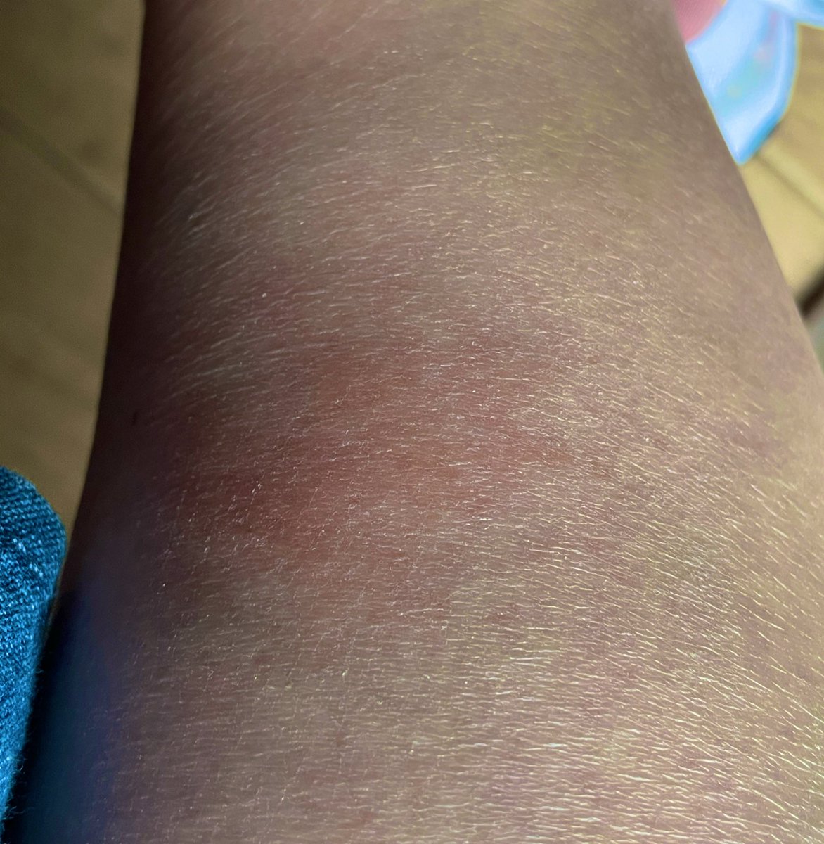何に刺されたんだろ…
　
触るとチクチクする⁉️

5箇所くらい😭