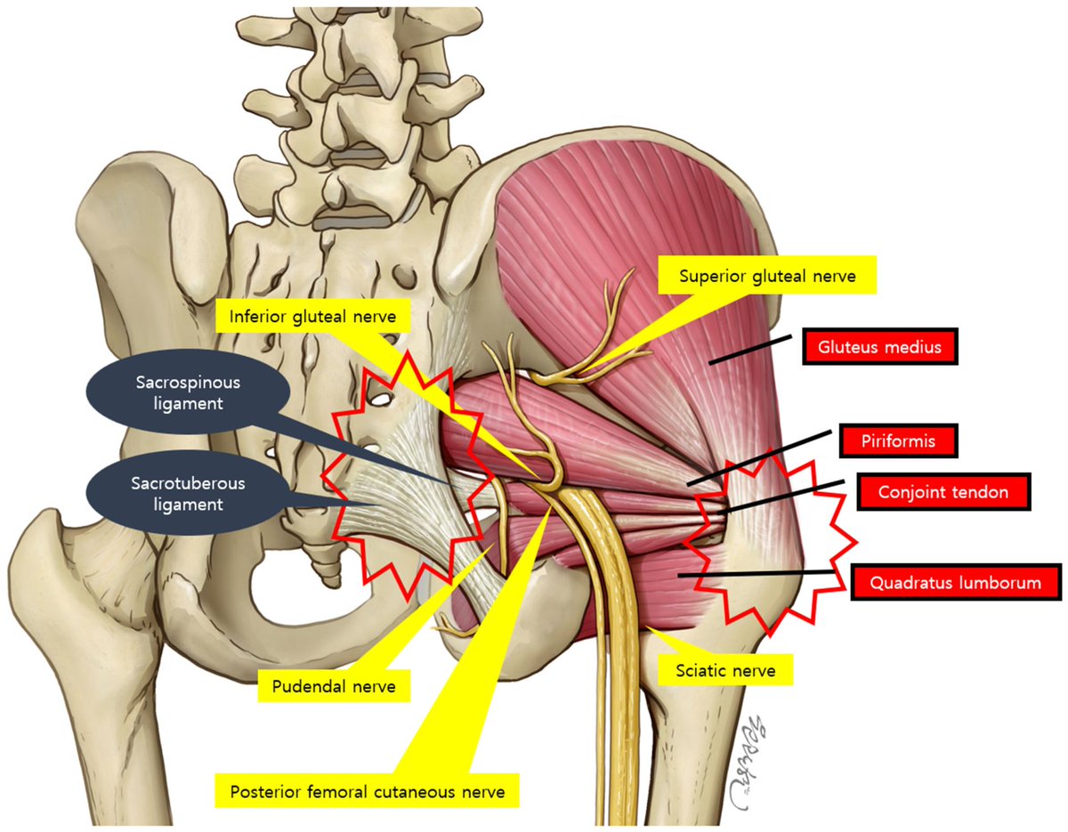 PhysioMeScience's tweet image. 𝗕𝗲𝘆𝗼𝗻𝗱  𝗡𝗲𝗿𝘃𝗲 𝗘𝗻𝘁𝗿𝗮𝗽𝗺𝗲𝗻𝘁: 𝗔 𝗡𝗮𝗿𝗿𝗮𝘁𝗶𝘃𝗲 𝗥𝗲𝘃𝗶𝗲𝘄  𝗼𝗳 𝗠𝘂𝘀𝗰𝗹𝗲–𝗧𝗲𝗻𝗱𝗼𝗻 𝗣𝗮𝘁𝗵𝗼𝗹𝗼𝗴𝗶𝗲𝘀 𝗶𝗻 𝗗𝗲𝗲𝗽  𝗚𝗹𝘂𝘁𝗲𝗮𝗹 𝗦𝘆𝗻𝗱𝗿𝗼𝗺

mdpi.com/2075-4418/15/1…