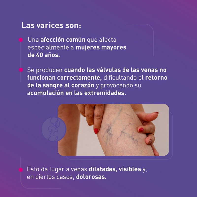 GrupoHLA's tweet photo. 👉 ¿Sabías que las #varices no solo son un problema estético?
➡ Esta afección venosa común, que se produce cuando las válvulas de las venas no funcionan correctamente, es posible tratarse gracias a los diferentes avances médicos.
🗒 En el #BlogHLA tienes todos los detalles⤵