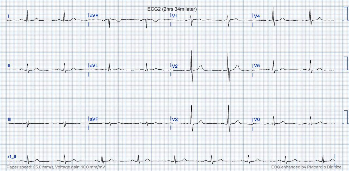 EcgOxford's tweet image. CP in healthy 42M
Echo: nl except RAC+MVP w mild MR
Dx?
@akneton @yolyabreuh @UlhasDr @DidlakeDW @ecgrhythms @IhabFathiSulima @DrPharmDMDTh @Vadeboncoeur_Al @smithECGBlog @EM_RESUS @estudiomedicina @OrlandoRPN @fxgodzeuss #FOAMcc @ResusMed @TrRja @NaokiThukishima @ecgandrhythmRoe