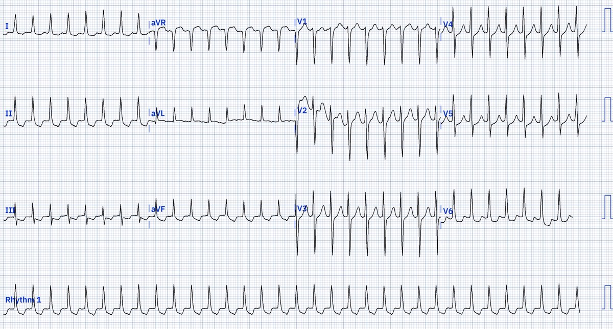 EcgOxford's tweet image. Palpitation in pt who was on long-term penicillin
Rhythm? 
@akneton @yolyabreuh @UlhasDr @DidlakeDW @ecgrhythms @IhabFathiSulima @DrPharmDMDTh @Vadeboncoeur_Al @smithECGBlog @EM_RESUS @estudiomedicina @OrlandoRPN @fxgodzeuss #EPeeps #FOAMcc @ResusMed @TrRja @NaokiThukishima…
