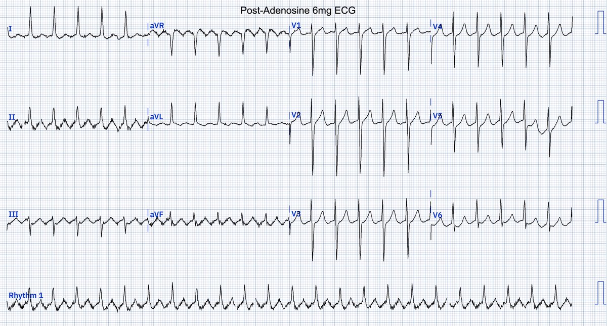 EcgOxford's tweet image. Palpitation in pt who was on long-term penicillin
Rhythm? 
@akneton @yolyabreuh @UlhasDr @DidlakeDW @ecgrhythms @IhabFathiSulima @DrPharmDMDTh @Vadeboncoeur_Al @smithECGBlog @EM_RESUS @estudiomedicina @OrlandoRPN @fxgodzeuss #EPeeps #FOAMcc @ResusMed @TrRja @NaokiThukishima…