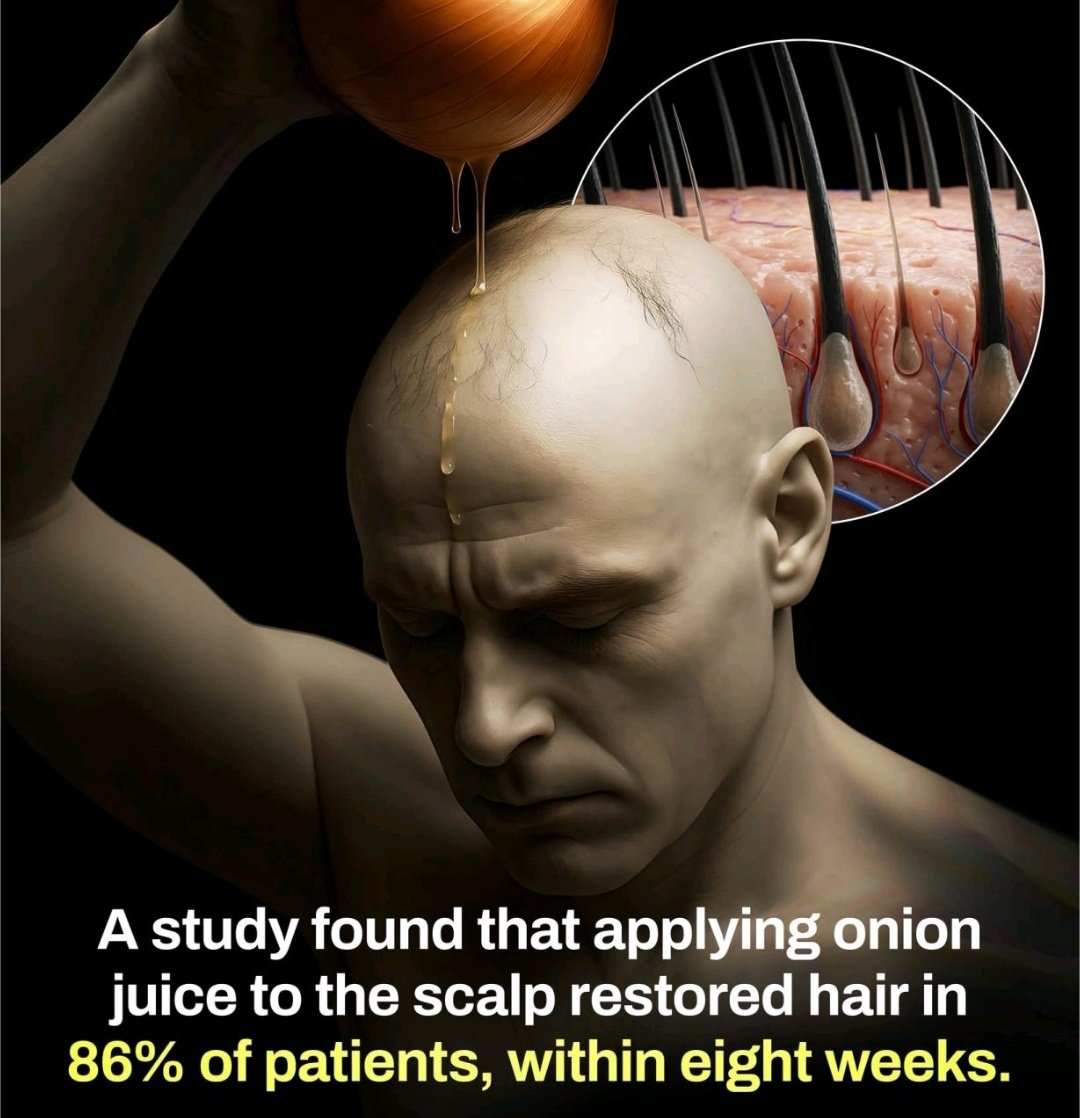 🚨 Saç Dökülmesine Soğanlı Çözüm mü? 🧅💡

Journal of Dermatology dergisinde yayınlanan küçük ama dikkat çekici bir çalışmada, alopesi areata (bölgesel saç dökülmesi) olan kişilerde soğan suyu denendi. Sonuçlar şaşırtıcı:

🔹 Günde 2 kez soğan suyu uygulaması → sadece 2 haftada