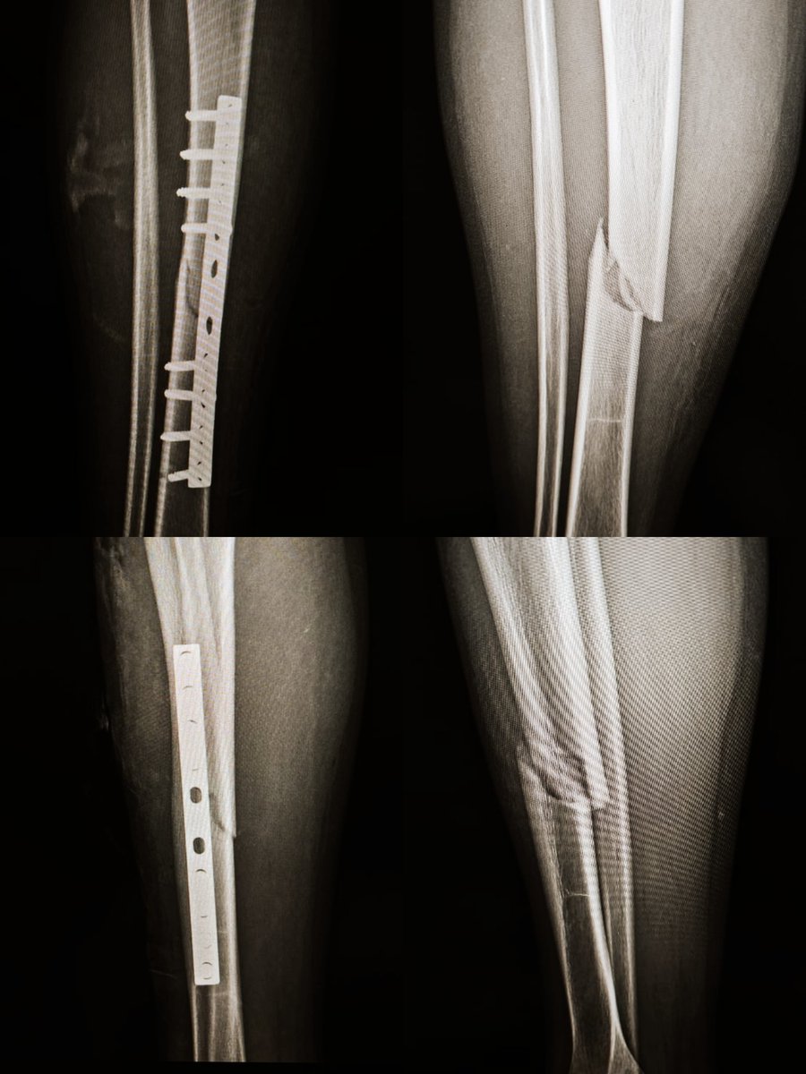 Mohamed Sabri 🇦🇹🏹🤍 (@mohamed01430791) on Twitter photo Male patient 15 yrs with fracture mid shaft tibia fixed by narrow DCP...
🥷🦴❤️ Male patient 15 yrs with fracture mid shaft tibia fixed by narrow DCP...
🥷🦴❤️