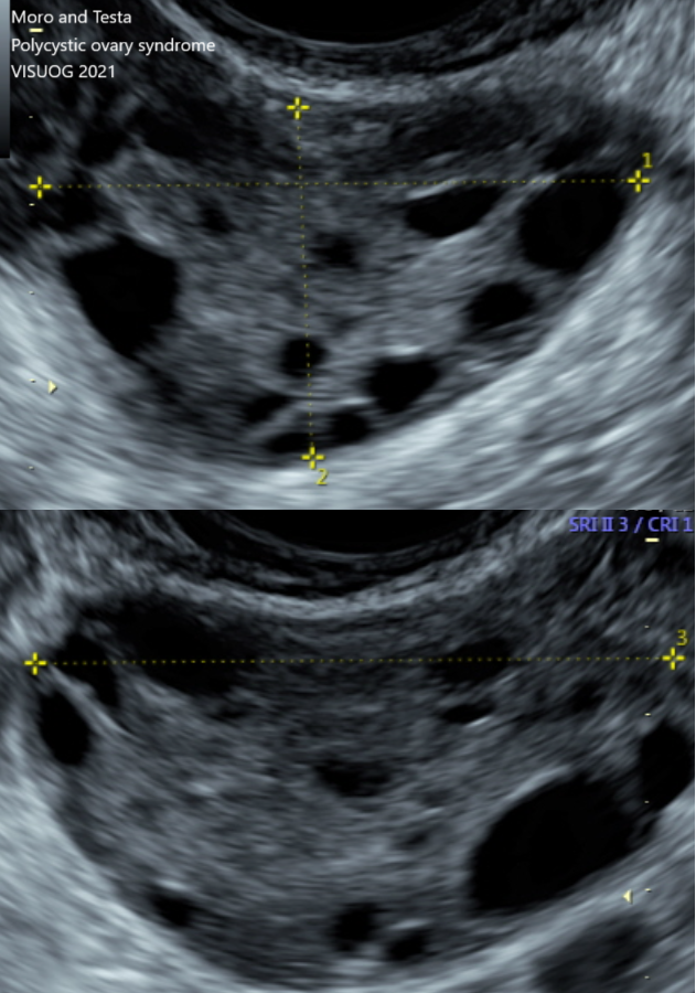 ISUOG's tweet photo. Further your knowledge of gynecological disorders this #PCOSAwarenessMonth! Take some time this month to explore recent #UOGJournal studies including cases of PCOS, like the study of Cooper et al., which described polycystic ovarian appearances in 15.6% of postmenarchal girls included but importantly highlights that this term is often used incorrectly in this population as multifollicular appearance is physiological within 8 years of menarche. Check it out here: https://t.co/V0JT8yXX9m