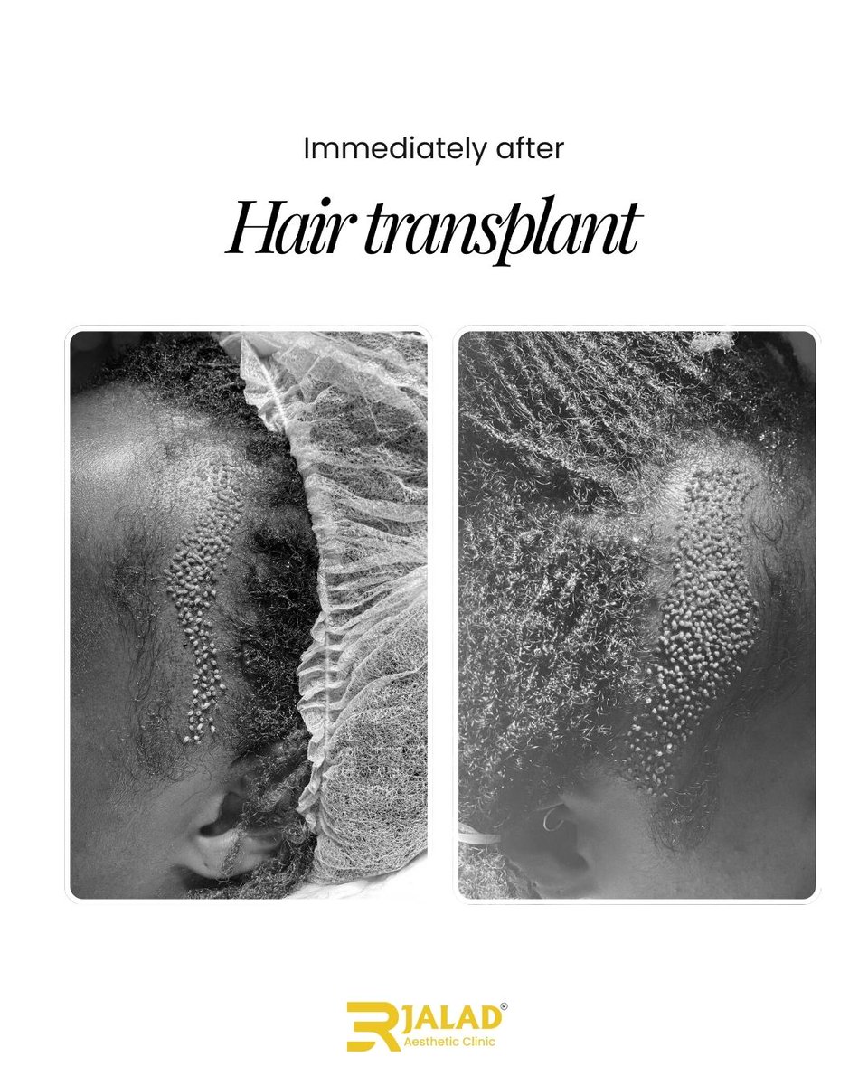 First 10 days post-transplant? Protect your grafts
No scratching
No hats
No sweaty gym sessions
Think of it as a short break for lifelong growth.