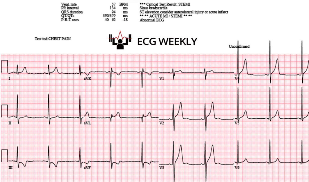 A 36-year-old man with hypertension and regular cannabis use (edibles, ~3x/week) is referred from clinic to the ED for chest pain and an abnormal ECG. His first ECG during pain is read as an anterolateral STEMI and is shown below....ecgweekly.com/weekly-workout…
