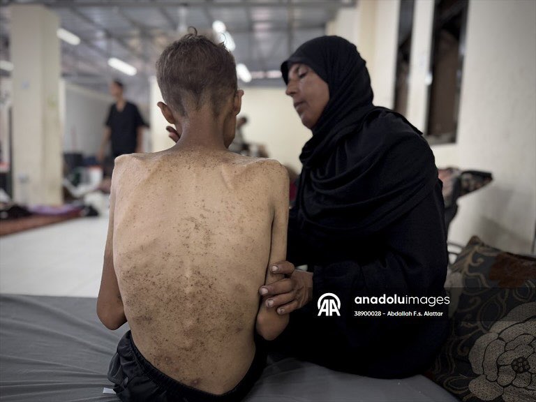 Abdallahallattr's tweet photo. The young Muhammad Riyad Atta Zenon (21 years) is lying in Nasser Medical Complex in Khanyunes, suffering from partial kidney failure and living with half a kidney, amid a life-threatening risk due to malnutrition and lack of treatment. As his sister Dima (14 years old) suffers https://t.co/xmRUpW0r7q