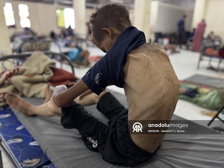 Abdallahallattr's tweet photo. The young Muhammad Riyad Atta Zenon (21 years) is lying in Nasser Medical Complex in Khanyunes, suffering from partial kidney failure and living with half a kidney, amid a life-threatening risk due to malnutrition and lack of treatment. As his sister Dima (14 years old) suffers https://t.co/xmRUpW0r7q