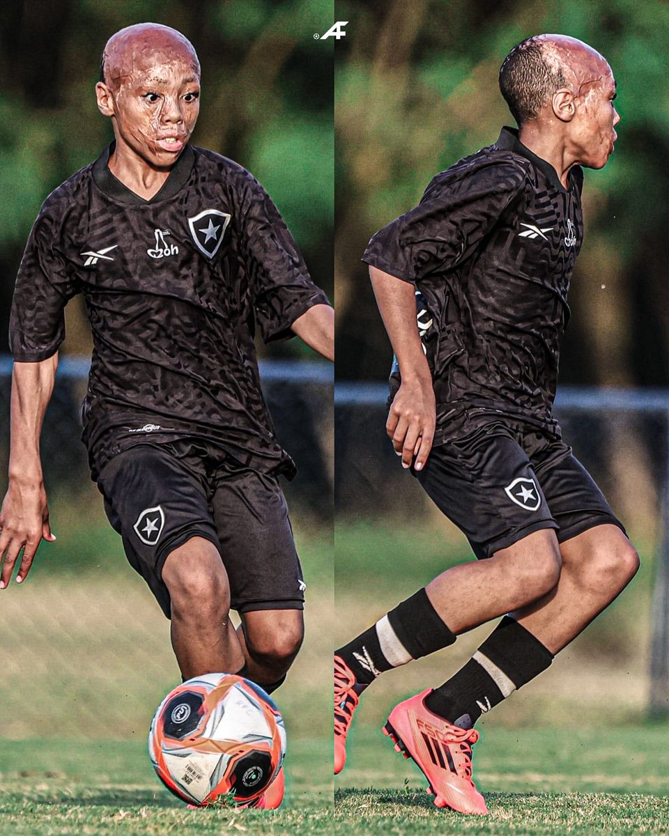 ❤️‍🩹 Esta historia es brutal. Bernardo Lopes tiene 11 años y ayer debutó en la Academia de Botafogo, con el Sub-11.

Con apenas un año de edad, sufrió un terrible accidente doméstico, tirándose el agua hirviendo de la caldera de su casa sobre toda la cara y el cuerpo.

Los médicos