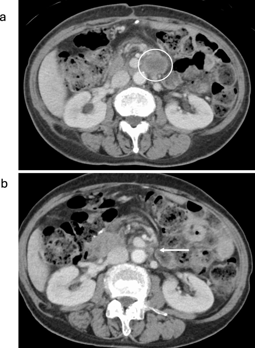 Wiley_CancerRep's tweet image. Sasaki et al. report a case where comprehensive genomic profiling identified microsatellite instability, high tumor mutational burden &amp;amp; actionable genetic mutations in cancer of unknown origin and gastric cancer.
doi.org/10.1002/cnr2.7…
#CancerReports #Wiley #CaseReport