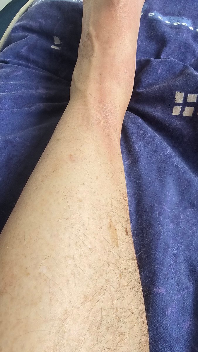 When you break your ankle 25 years ago and it decides to flare up for no reason. Absolute agony